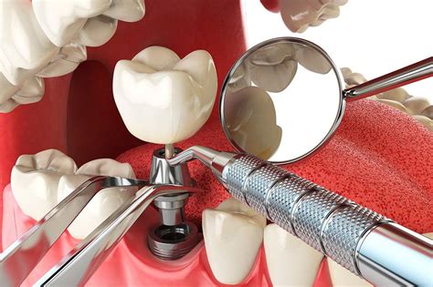 Implantes Dentales Inmediatos En Burgos Cl Nica Nu O Gil