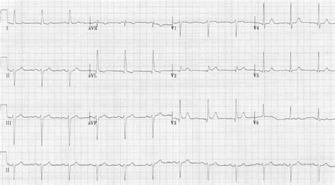 Left Anterior Fascicular Block Lafb • Litfl • Ecg Library Diagnosis