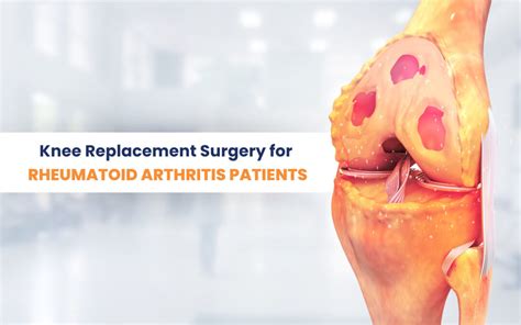 Knee Replacement Surgery for Rheumatoid Arthritis Patients: A Game ...