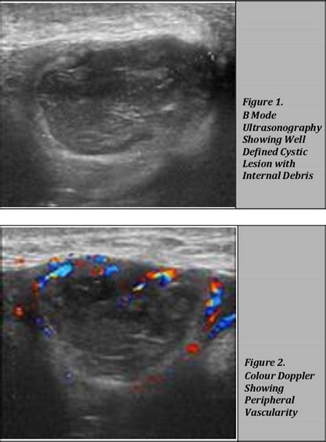 Figure From Infected Bartholin Cyst Ultrasonography Doppler