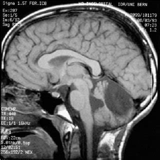 Sagittal T Weighted Image Mm Thick Slice Tr Ms Te Ms