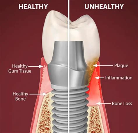 Peri Implantitis Causes Prevention And Treatment Options Dentalprof