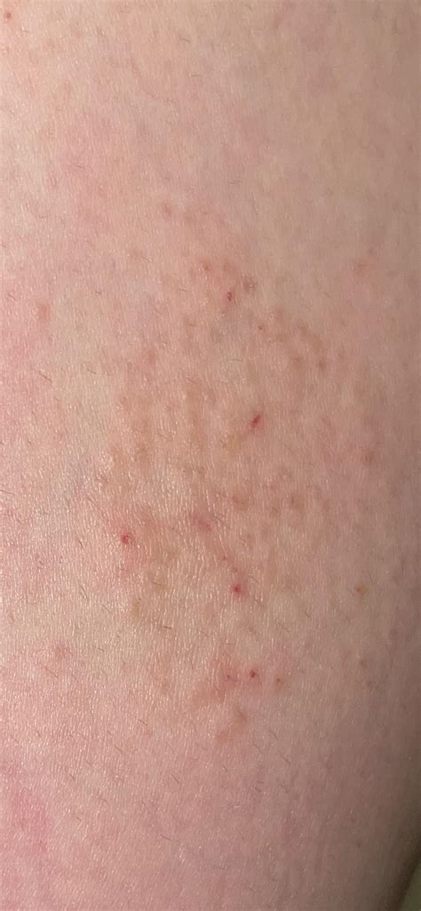 Rash On Side Of Thigh I’ve Had It For Over Three Months R Dermatologyquestions