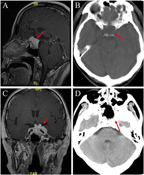 Frontiers Case Report Clinical Report Of Co Occurrence Of Pituitary