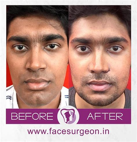 All That You Wanted To Know About Jaw Plastic Surgery Richardsons