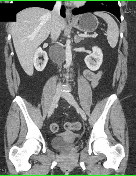 Schwannoma In The Right Para Aortic Region Gastrointestinal Case