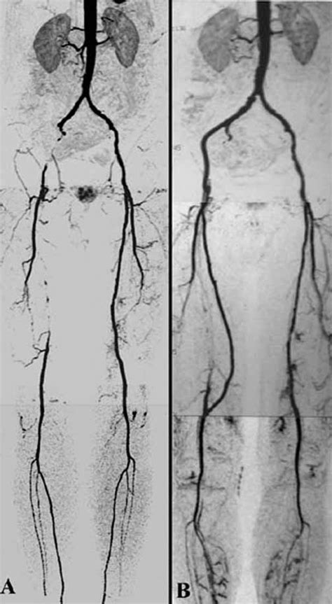 Preoperative Contrast Enhanced Three Dimensional Mr Angiography Of A Download Scientific