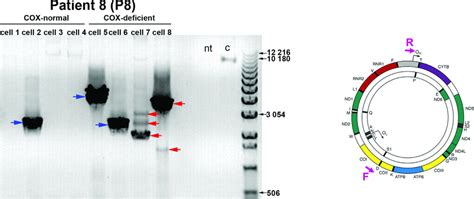 Long Range Pcr Analysis Of Mtdna From Individual Myofibres From A Sibm