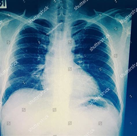 Pulmonary Tuberculosis Tb Chest X Ray Show Alveolar Infiltration