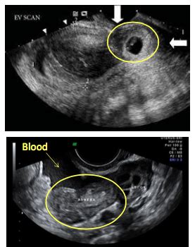 Ectopic Pregnancy Ob Sono Flashcards Quizlet