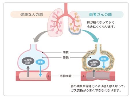 間質性肺炎とは？ 福島県郡山市リウマチ膠原病医のブログ（おおがクリニック）