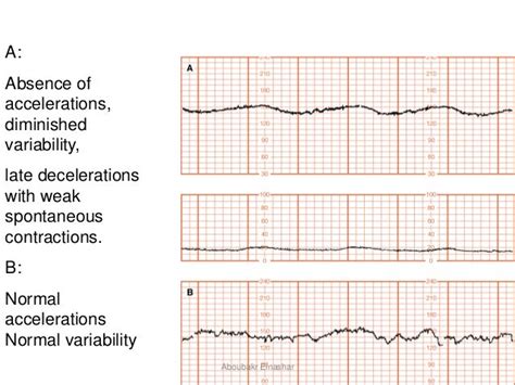 Cardiotocography Ctg Antepartum And Intrapartum