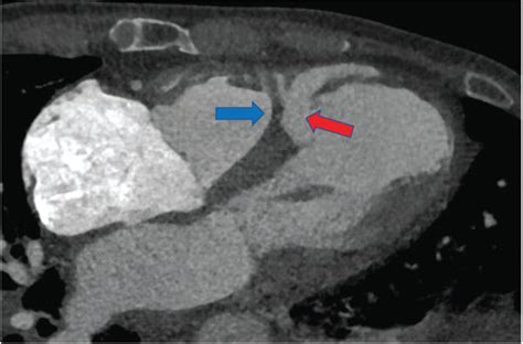 A Preoperative Horizontal Plane Imaging By Cardiac CTA B