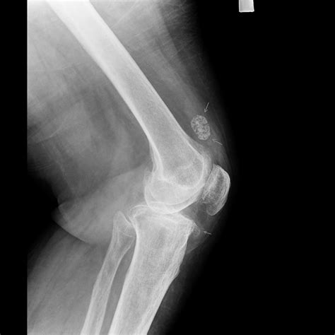 Secondary Synovial Chondromatosis Of The Knee Image Radiopaedia Org