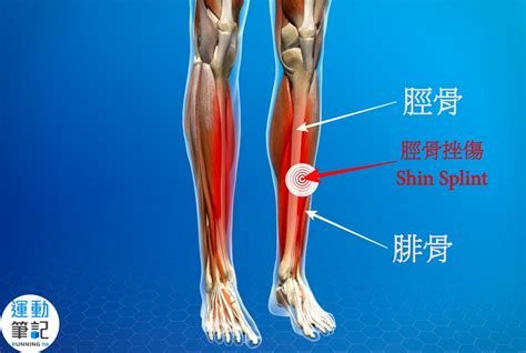 【跑步科學】小心過度訓練，脛骨挫傷知多啲！ ｜ 運動筆記hk