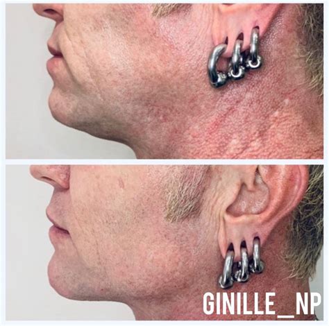 Jawline Filler Before And After Strong Male Jawline Chiseled Jawline