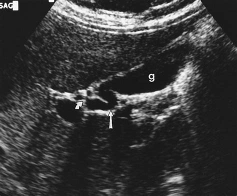 Gallbladder Cystic Duct