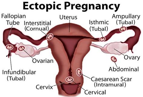 Ectopic Pregnancy Causes Signs Symptoms Diagnosis Treatment