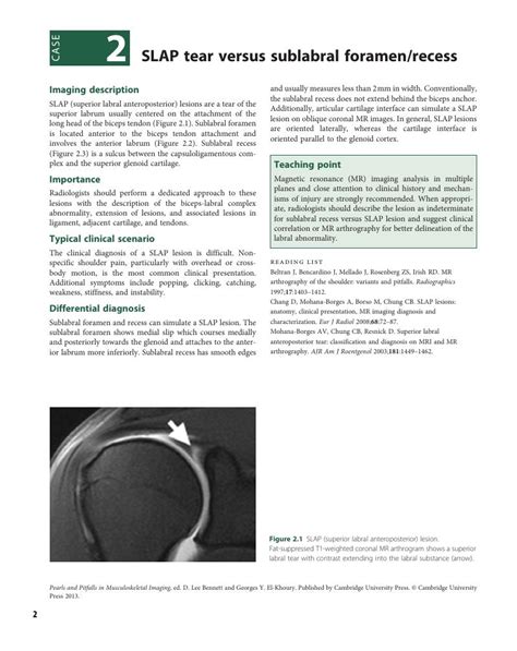 SLAP tear versus sublabral foramen/recess (Case 2) - Pearls and ...