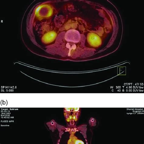 FDG PET CT With A Trans Axial And B Coronal Views PET CT Scan