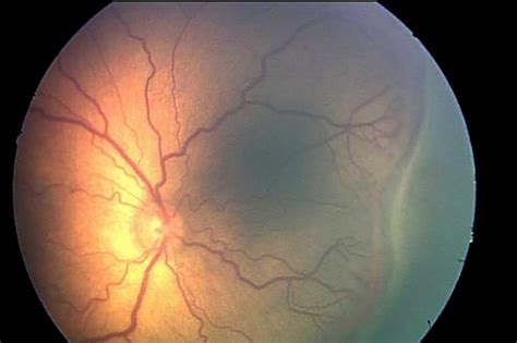 New retina model may eventually predict outcome of eye diseases - UPI.com