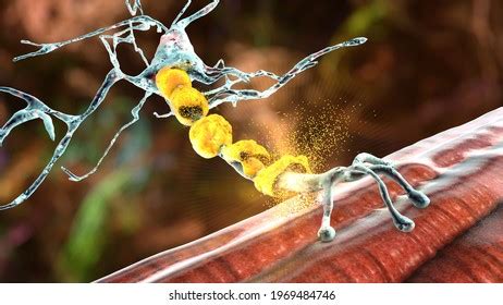 Demyelination Neuron Damage Neuron Myelin Sheath Stock Illustration ...