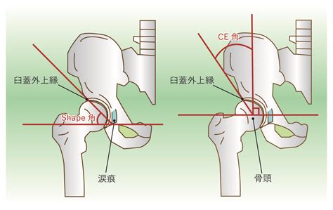 変形性股関節症の原因と日常生活で気をつけること 整形外科医師による関節の痛み情報サイト