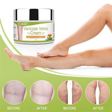 ELAIMEI Varicose Veins Cream 50g Varicosity Ointment Relief Veins