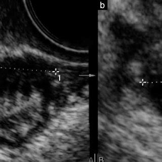 Sagittal Transvaginal Ultrasound TVS Image Of The Rectosigmoid