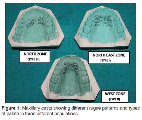 Correlation Of Palatal Rugoscopy With Gender Palatal Vault Heig