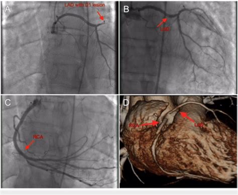 Angiographic Findings And Cardiac Computed Tomography Ct Imaging Of