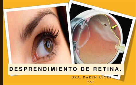 Presentaci N Desprendimiento De Retina Kira Udocz