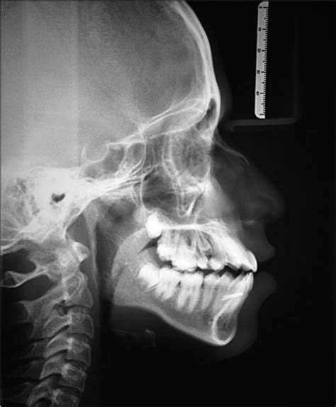 Non Surgical Correction Of Class Iii Adolescent Patient With Tads And Damon System A Case