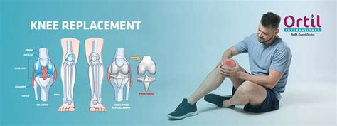 Success Rate of Knee Replacement Surgery in India | Ortil Healthcare