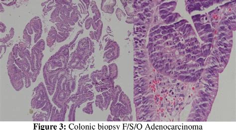 Figure 3 From Colonic Adenocarcinoma Presenting As Hemophagocytic