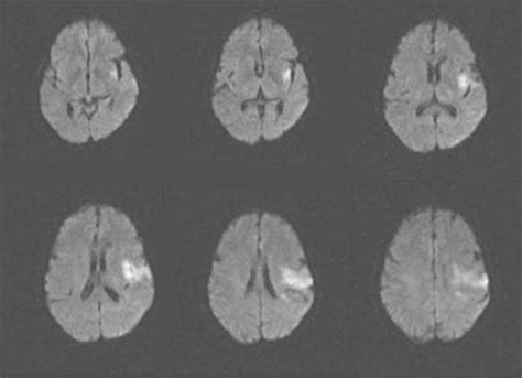 Image Acute Ischemic Stroke In The Left Insular And Frontal Lobes Mri Merck Manuals