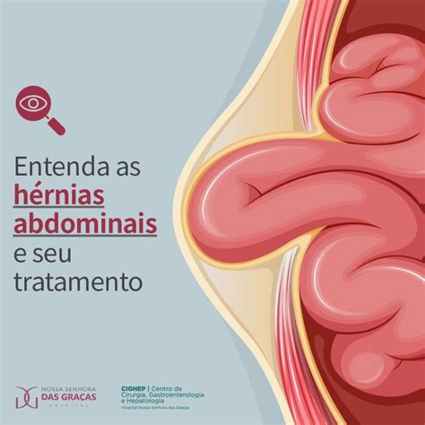 Entenda as hérnias abdominais e seu tratamento Cighep