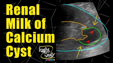 Milk Of Calcium Kidney Ultrasound