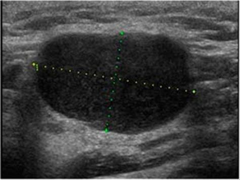 Cystic Neck Lymph Nodes Ultrasound