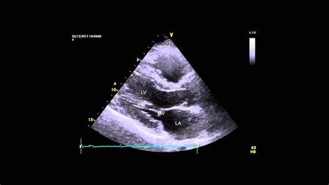 Parasternal Long Axis Plax View Of A Normal Heart Youtube