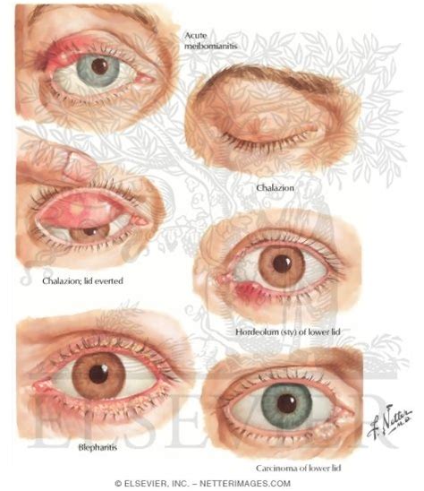 Eyelid Infection and Conjunctival Disorders