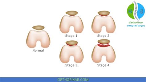 Knee Grinding Test