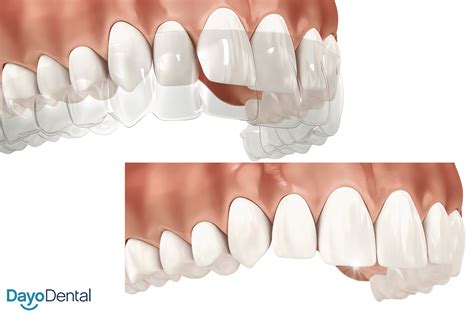 Can Invisalign Fix Overbite? Procedure, Benefits, and Cost