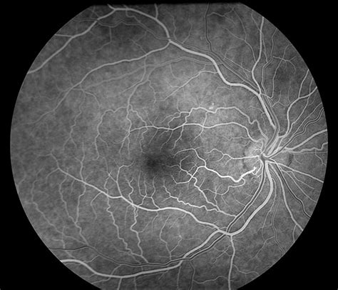 Fluorescein Angiography Department Of Ophthalmology And Visual Sciences