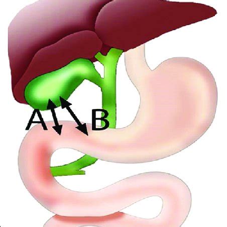 Initial Puncture Site In EUS Guided Gallbladder Drainage A Duodenal