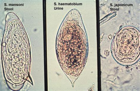 Egg Of Schistosoma Medical Laboratory Science Medical Laboratory