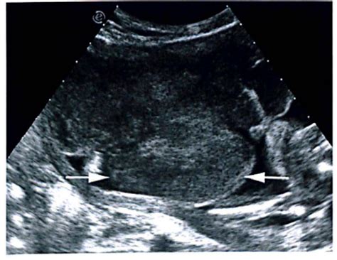 Figure 1 From Ultrasound And Colour Doppler Of Placental Chorioangioma