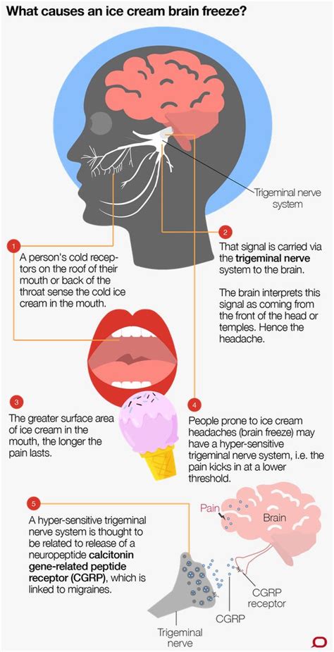 Everything About Sphenopalatine Ganglioneuralgia Brain Freeze