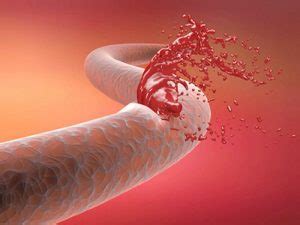 Arteriosclerosis: Symptoms, Causes, Treatment, Prevention and ...