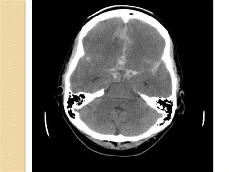 Imaging In Head Trauma